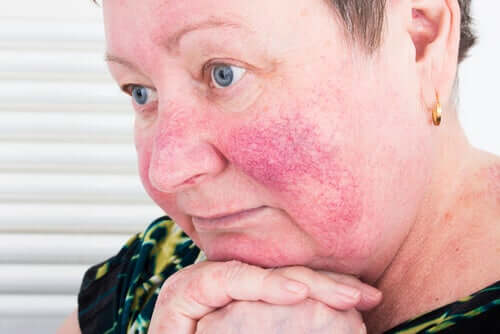 Acne e rosacea