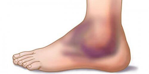 Distorsioni: cause e trattamento