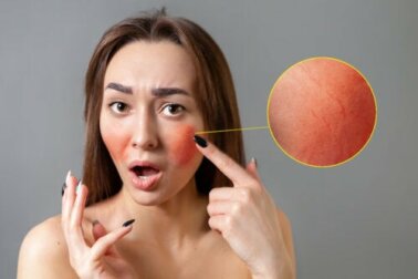 Rosacea: consigli e trattamenti per combatterla