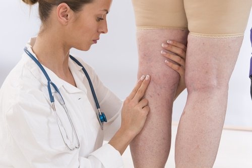 dottoressa e gambe con ritenzione idrica