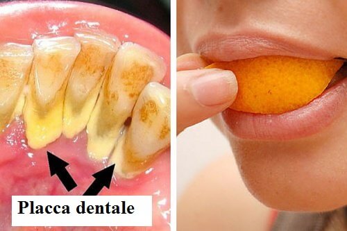 Eliminare la placca dentale: i 5 rimedi naturali più efficaci