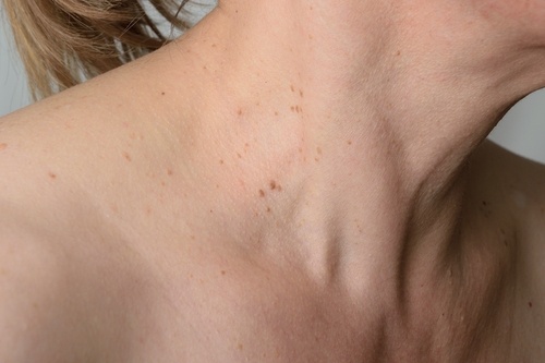 Rimedi naturali contro le verruche: 8 trattamenti