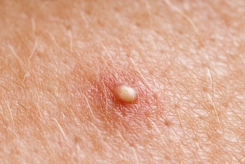 Cisti sebacee: eliminarle con rimedi naturali