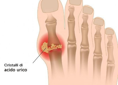 Cos'è e come si controlla l'acido urico nell'organismo