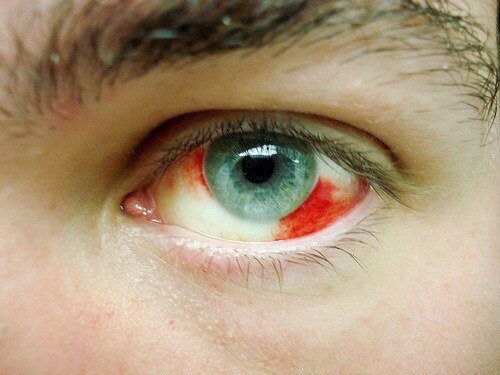 Emorragia agli occhi, quali sono le cause?