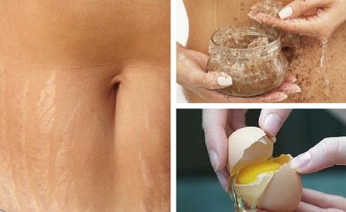 Consigli per evitare o attenuare le smagliature