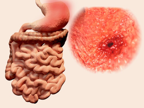 5 frullati naturali per alleviare le ulcere gastriche 5 frullati naturali per alleviare le ulcere gastriche