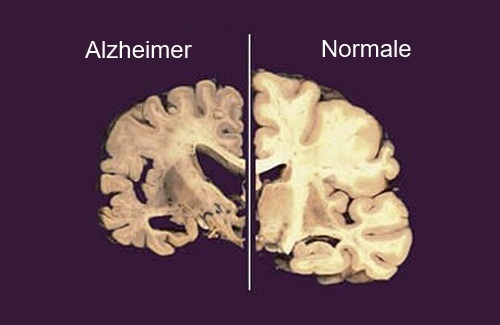 Cervello-con-Alzheimer-e-sano