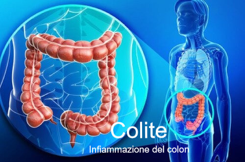 La colite si combatte con 6 trattamenti naturali