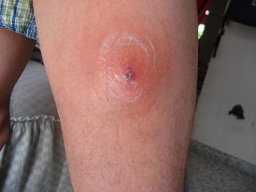 Puntura di pulci: trattamento e prevenzione