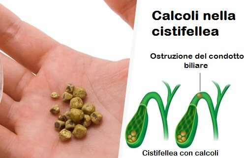 Eliminare i calcoli alla cistifellea con 7 succhi e bevande