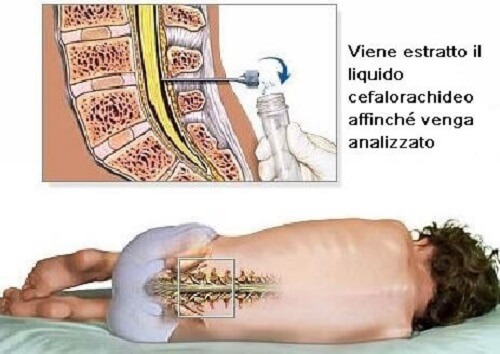 analisi con puntura lombare