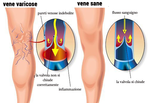 le vene varicose