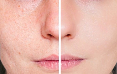 Trattamento al pomodoro per le pelli grasse e con acne