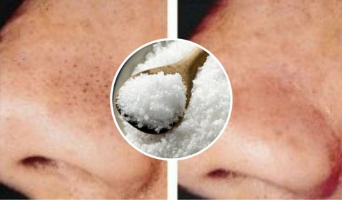 Punti neri e brufoli: come combatterli con il sale