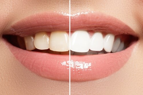 Sbiancante per denti