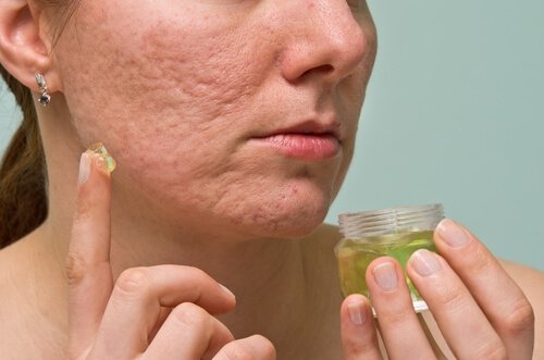 Trattamento contro l'acne