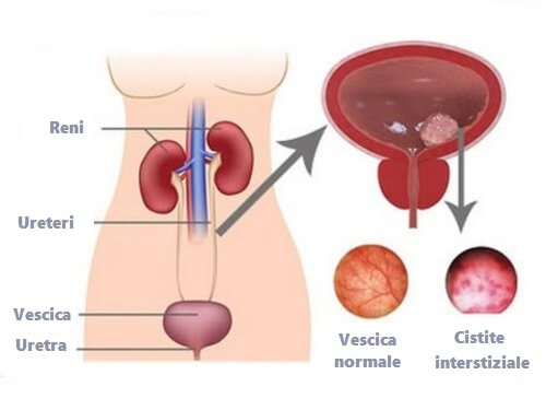 Trattare la cistite con rimedi naturali