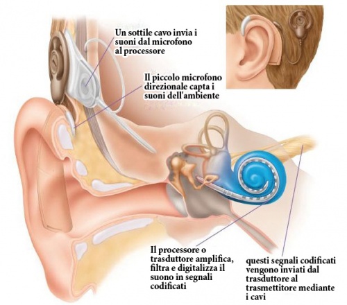 Impianto cocleare udito