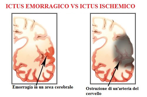 ictus emorragico vs ictus ischemico