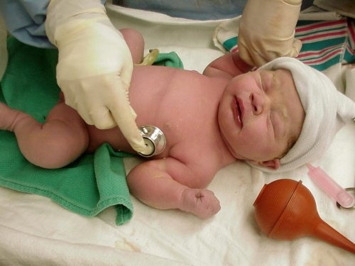 neonato parto cesareo