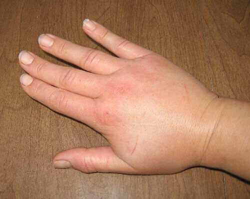 mano gonfia ritenzione idrica