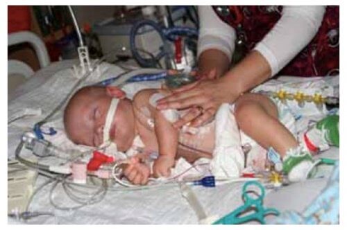 neonato intubato batteria a bottone