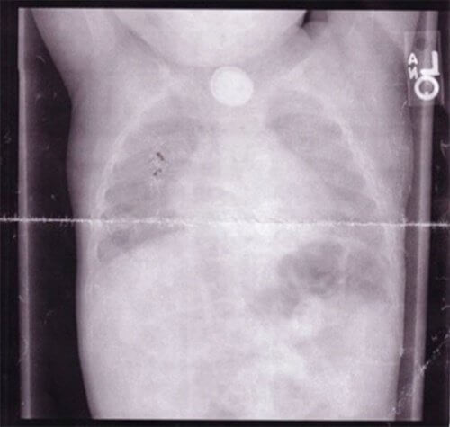 radiografia toracica batteria a bottone