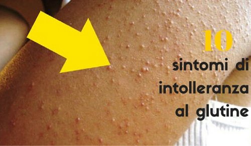 Sensibilità al glutine: come riconoscerla