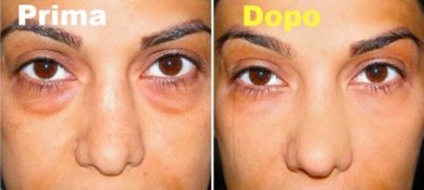 5 rimedi per attenuare le borse degli occhi