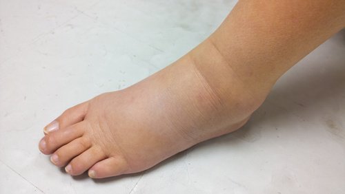 Edema o infiammazione reni