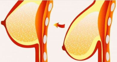 Prevenire il seno cadente grazie a 8 consigli