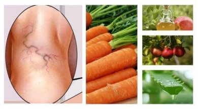 Trattamento naturale per le varici con aloe vera, carote e aceto di mele