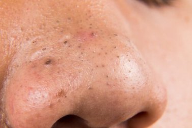 5 rimedi naturali per eliminare i punti neri