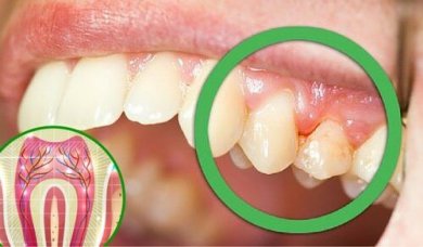 6 motivi per cui potete soffrire di mal di denti