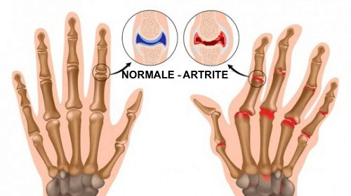 artrite