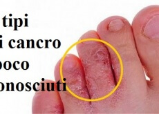 Come curare la psoriasi a forma di lacrima