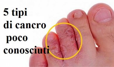 Tipi di cancro poco conosciuti, eccone 5
