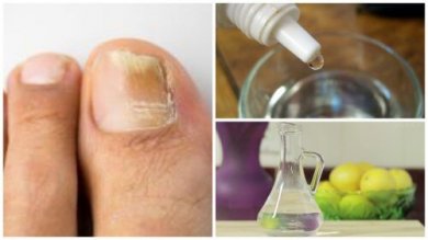 Antimicotico per le unghie da preparare in casa