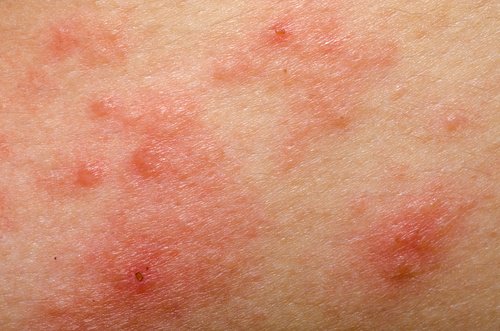 pelle con dermatite