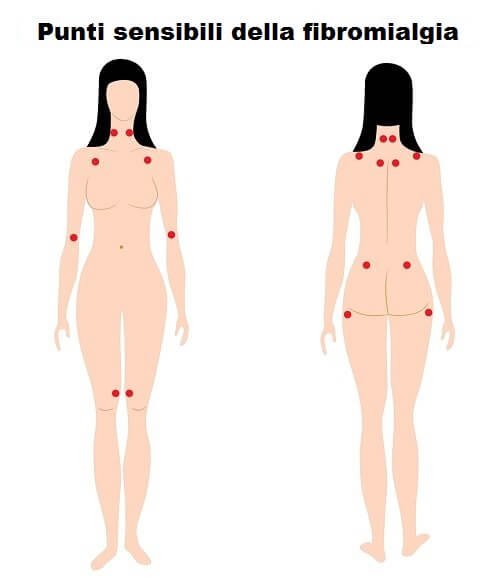 sintomi di fibromialgia punti sensibili