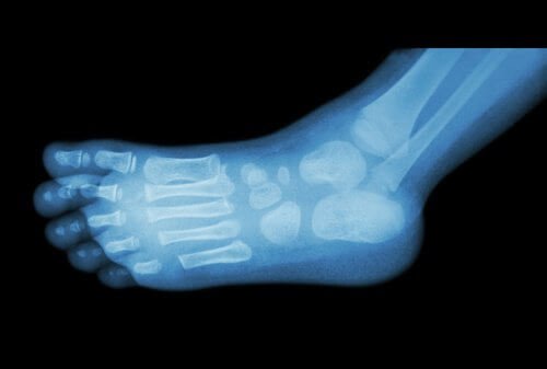 radiografia del piede