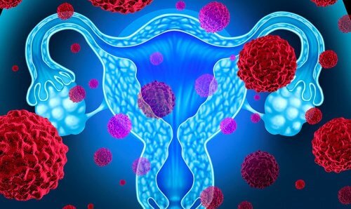 Tumore endometriale: aspetti da tenere in considerazione
