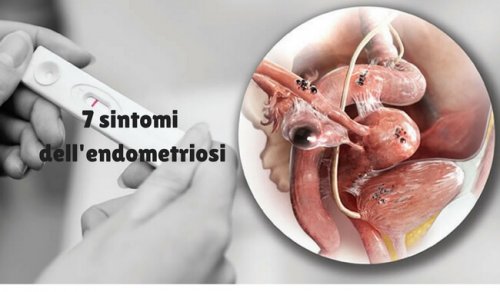 Sintomi dell'endometriosi: quali sono?