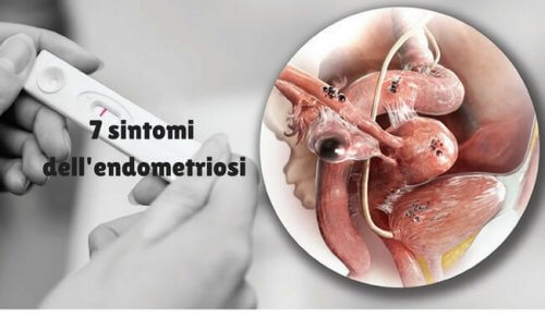 Endometriosi - Endometriosi Sintomi Diagnosi E Trattamento | consiefrist