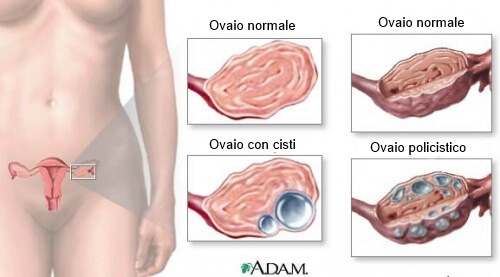 Cisti ovariche: 9 cose che ogni donna deve sapere