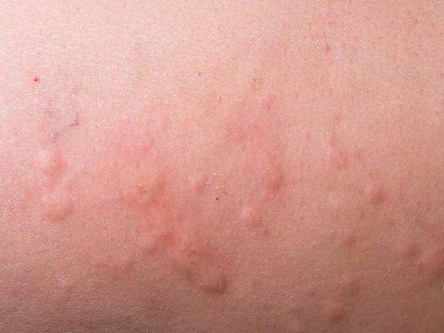Eruzione cutanea stress