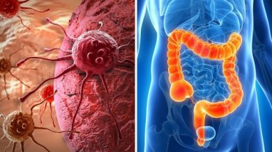 Possibili sintomi di cancro al colon