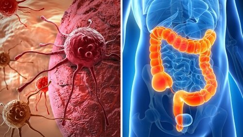 Possibili sintomi di cancro al colon