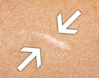 Cicatrizzare le ferite: ecco i migliori rimedi naturali